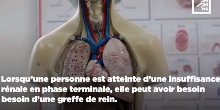 SANTE – La greffe des reins n’est pas pour tous les patients atteints d’insuffisance rénale