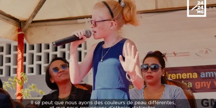 SOCIETE – Le quotidien difficile des personnes atteintes d’albinisme dans le Sud de Madagascar
