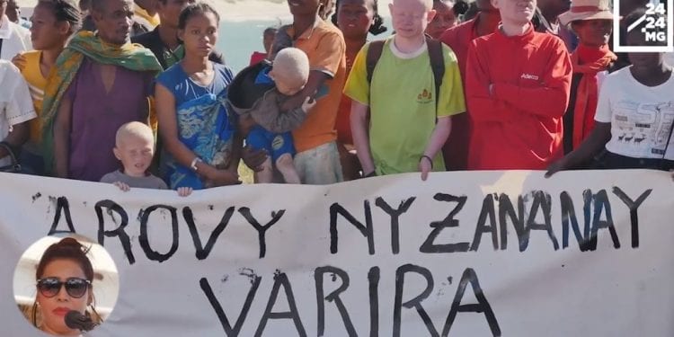 TOLAGNARO – Une journée pour sensibiliser à l’albinisme et pour s’engager contre les violences faites aux « albinos »