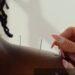 SANTÉ PUBLIQUE – L’acupuncture, médecine traditionnelle millénaire chinoise, en 50 ans de pratique à Madagascar